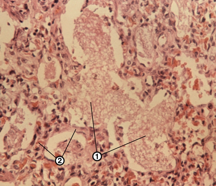 Рис. 7. Микропрепарат легкого при пневмоцистозе: в просветах альвеол видны скопления пневмоцист (1), межальвеолярные перегородки (2) несколько утолщены, инфильтрированы лимфоцитами и плазмоцитами; окраска гематоксилином и эозином; ×600