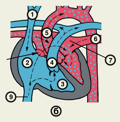 Рис. 23б). Схематическое изображение отдельных врожденных пороков сердца (направления кровотока обозначены пунктирными стрелками, локализация пороков — сплошными стрелками): аномалия Эбштейна — смещение трехстворчатого клапана в сторону правого желудочка, сопровождающееся его деформацией, увеличением полости правого предсердия и уменьшением полости правого желудочка; 1 — верхняя полая вена, 2 — правое предсердие, 3 — правый желудочек, 4 — легочный ствол, 5 — аорта, 6 — легочная вена, 7 — левое предсердие, 9 — нижняя полая вена