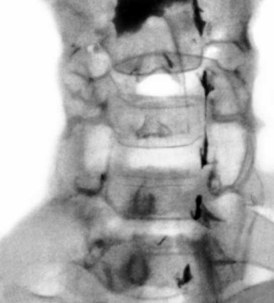 Рис. 6. Миелограмма шейного отдела позвоночника при опухоли, растущей в направлении позвоночного канала: рентгеноконтрастное вещество не проходит ниже уровня четвертого шейного позвонка