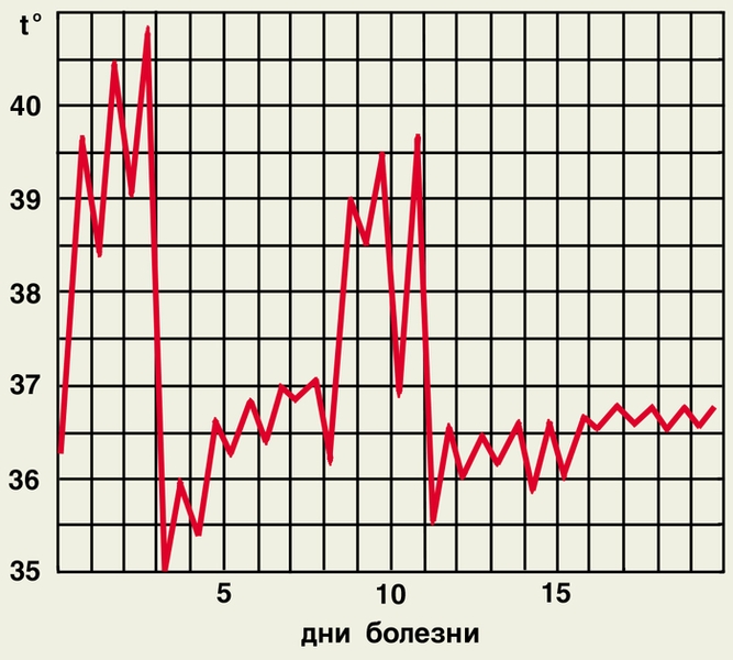 Рис. 2г). Температурные кривые при различных типах лихорадки — возвратная