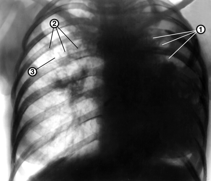 Рис. 13а). Рентгенограмма органов грудной клетки в прямой проекции больной фиброзно-кавернозным туберкулезом правого легкого и левосторонней казеозной пневмонией: левое легкое уменьшено в объеме, диффузно затенено, в верхних его отделах определяются множественные полости распада (1); правое легкое увеличено в объеме, в средних его отделах определяются очаги отсева (2), на уровне второго межреберного промежутка — каверна (3); тень средостения смещена влево