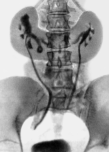 Рис. 4. Экскреторная урограмма при подковообразной почке: выпуклая часть почки обращена вниз