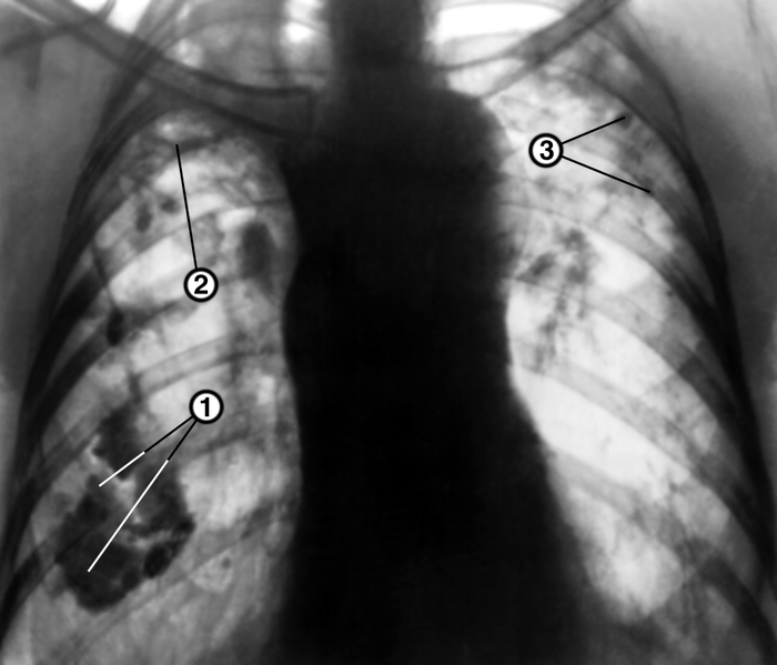 Рис. 23. Рентгенограмма органов грудной клетки в прямой проекции при цирротическом туберкулезе легких: правое легкое затенено и уменьшено в объеме за счет фиброза и массивных плевральных наслоений, в реберной плевре определяются кальцинаты (1), на уровне ключицы в правом легком видна хроническая каверна (2), легочный рисунок резко деформирован с обеих сторон, в левом легком имеются рассеянные высокоинтенсивные тени старых очагов (3), тень трахеи смещена вправо, срединная тень деформирована