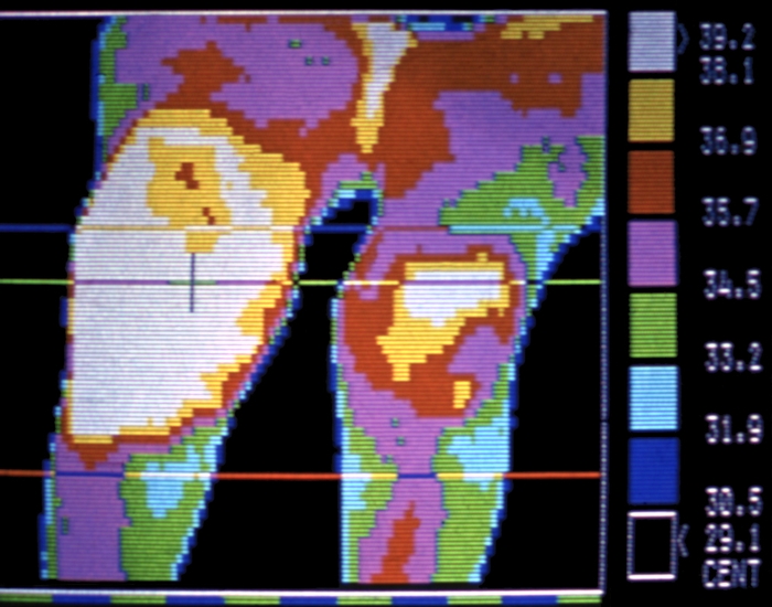 Рис. 11. Термограмма согнутых коленных суставов (передняя проекция) при обострении ревматоидного артрита: правый коленный сустав резко деформирован, увеличена теплопродукция обоих суставов