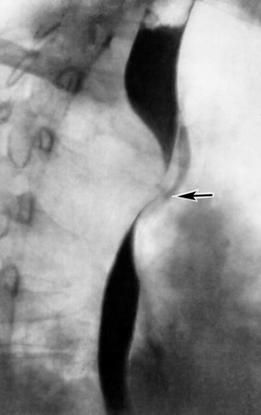 Рис. г). Рентгенологическая картина при различных заболеваниях и поражениях пищевода, сопровождающихся дисфагией: <a href=