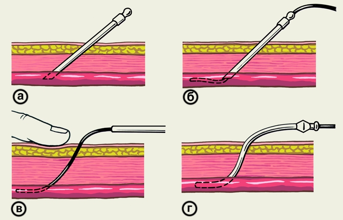 Рис. 2. Схема этапов чрескожной катетеризации по Сельдингеру: а — <a href=