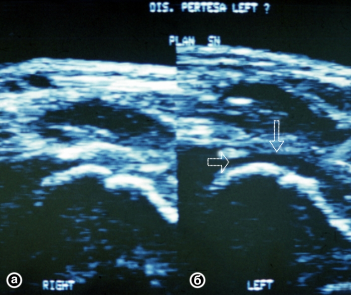 Рис. 22. Ультрасонограммы тазобедренных суставов ребенка 5 лет в норме (а) и при болезни Пертеса в ранней ее стадии (б): контур головки бедренной кости не изменен, в полости тазобедренного сустава определяется скопление жидкости (указано стрелками)