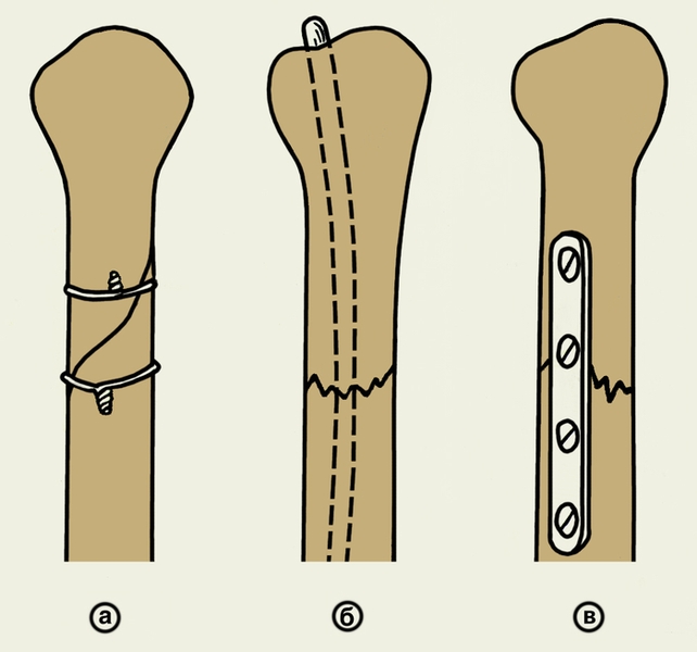 Рис. 1. Виды погружного остеосинтеза: а — накостный (проволочными швами); б — внутрикостный (гвоздем Богданова); в — накостный (пластиной)