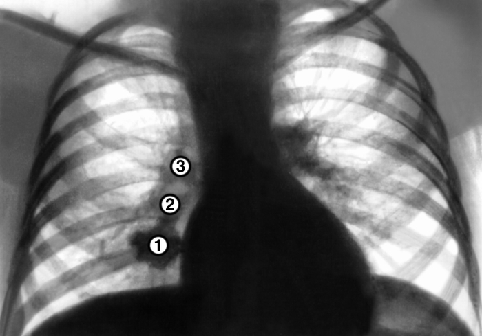 Рис. 2 а). Рентгенограмма органов грудной клетки в прямой проекции при первичном туберкулезном комплексе: участок затенения в легком (1) соединен «дорожкой» (2) с увеличенными лимфатическими узлами корня легкого (3)