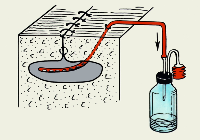 Рис. 3а). Вакуумное дренирование по Редону: аспирация содержимого