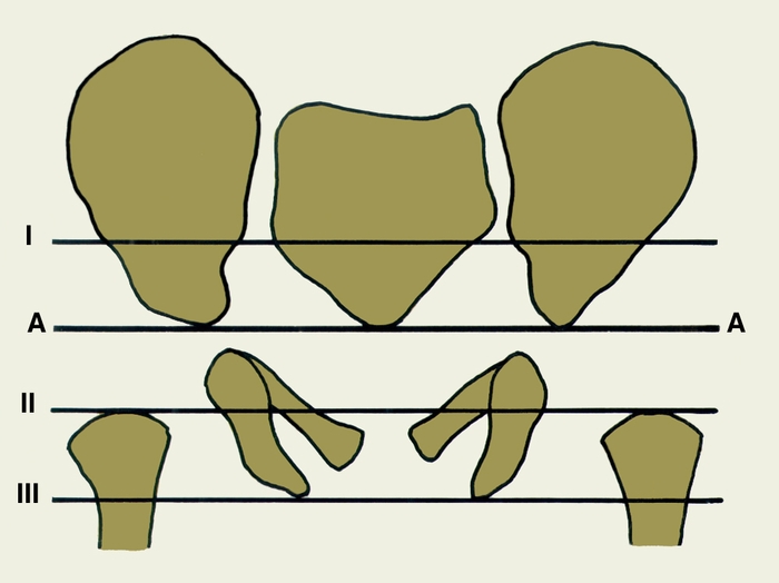 Рис. 3. Схематическое изображение костных ориентиров (контрольных горизонталей) для проверки правильности укладки при рентгенографии тазобедренных суставов у детей 1 года: I — линия, проходящая через нижние края крестцово-подвздошных сочленений; АА — основная горизонталь, проходящая через У-образные хрящи у нижних краев тел подвздошных костей; II — линия, проходящая через верхние края запирательных отверстий; III — линия, проходящая через нижние края седалищных костей