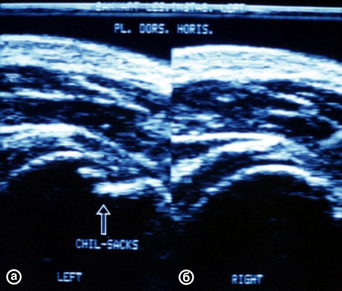 Рис. 20. Ультрасонограммы плечевых суставов (задний горизонтальный срез) при импрессионном переломе головки левой плечевой кости (а) и в норме (б): контур головки плечевой кости ступенеобразно деформирован в месте импрессии (указано стрелкой)