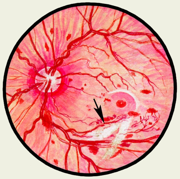 Рис. 15. Глазное дно в норме и при патологии. Прогрессирующая диабетическая ретинопатия: стрелкой указан соединительнотканный тяж