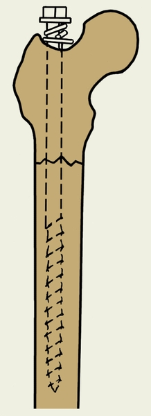 Рис. 10. Внутрикостный остеосинтез подвертельного перелома бедра штифтом-штопором Сиваша