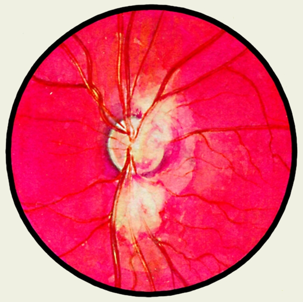 Рис. 17. Глазное дно в норме и при патологии. Ревматический ретиноваскулит: сосуды сетчатки в области диска зрительного нерва и около него окружены своеобразными муфтами, представляющими собой участки помутневшей (отечной) сетчатки