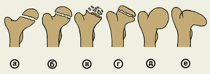 Рис. 2. Схематическое изображение эволюции изменений головки бедренной кости при болезни Легга — Кальве — Пертеса: а — I стадия (асептический некроз кости), изменения на рентгенограмме не выявляются; б — II стадия (импрессионный перелом); в — III стадия (рассасывания), пораженный участок состоит из плотных бесструктурных фрагментов неправильной формы; г — IV стадия (регенерации), восстановление формы кости; д — V стадия, деформирующий <a href=