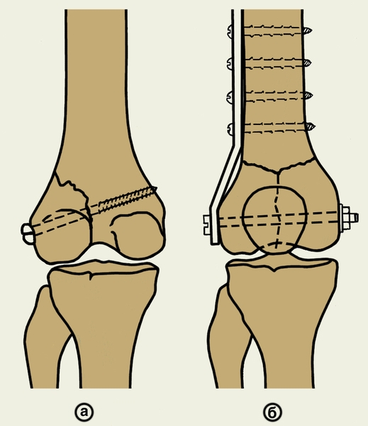 Рис. 11. Остеосинтез мыщелков бедренной кости: а — винтом; б — пластиной и болтом