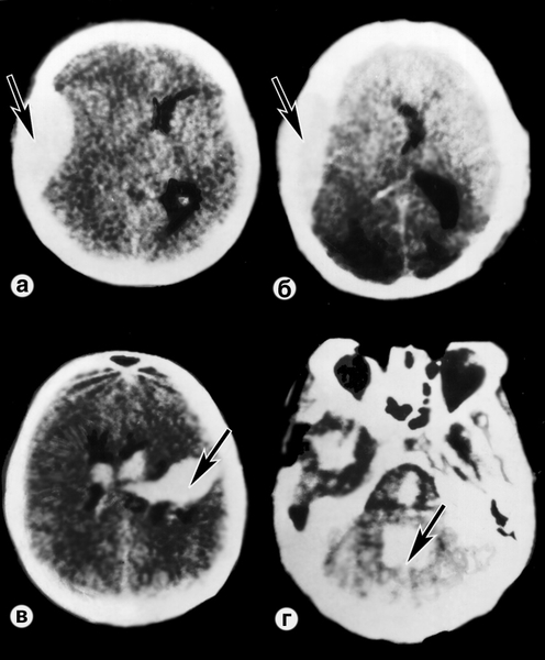 Рис. 2. Компьютерные томограммы при черепно-мозговой травме, сопровождающейся компрессией головного мозга: а — эпидуральная гематома (указана стрелкой); б — субдуральная гематома (указана стрелкой); в — внутримозговая гематома с прорывом в боковые желудочки (указана стрелкой); г — внутрижелудочковая гематома (IV желудочек, указана стрелкой)