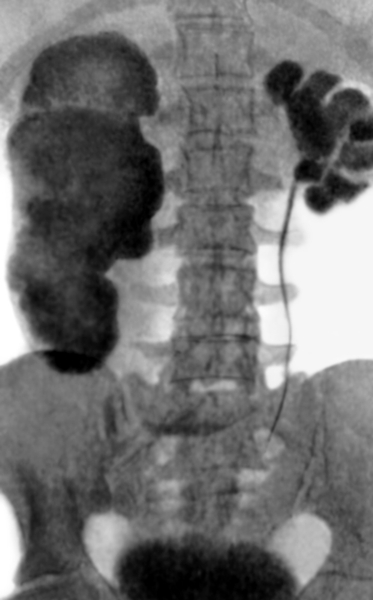 Рис. 2. Урограмма при двустороннем гидронефрозе: с обеих сторон видны четко контрастированные полости на месте резко расширенных почечных чашечек и лоханок