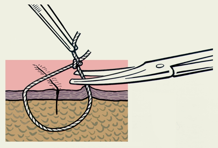 Рис. 12. Схематическое изображение этапа снятия узлового кожного шва: потягиванием за узел на поверхность выведен находившийся под кожей участок нити, который пересекают ножницами