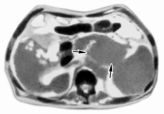 Рис. 14. Компьютерная томограмма эпигастральной области при раке тела и хвоста поджелудочной железы (зона поражения указана стрелками)