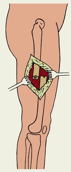 Рис. 3а). Открытый внутрикостный остеосинтез бедра: разрез мягких тканей