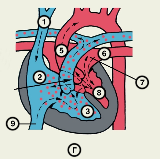 Рис. 23г). Схематическое изображение отдельных врожденных пороков сердца (направления кровотока обозначены пунктирными стрелками, локализация пороков — сплошными стрелками): атриовентрикулярный канал (полная форма) — патологическое сообщение между предсердиями и желудочками, формирующееся в результате сочетания дефектов межпредсердной и межжелудочковой перегородок с деформацией атриовентрикулярных клапанов; 1 — верхняя полая вена, 2 — правое предсердие, 3 — правый желудочек, 5 — аорта, 6 — легочная вена, 7 — левое предсердие, 8 — левый желудочек, 9 — нижняя полая вена