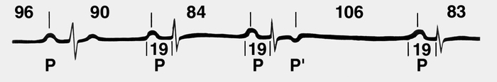 Рис. 8. ЭКГ при предсердной форме реципрокного ритма. Р — нормальный предсердный зубец. В третьем комплексе отчетливо виден зубец Р (отрицательный, следующий за неизмененным желудочковым комплексом), который отражает возвращение волны возбуждения в <a href=