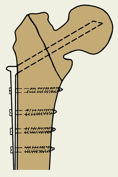 Рис. 9. Чрескостно-накостный остеосинтез вертельного перелома бедра двухлопастным металлическим фиксатором с диафизарной накладкой