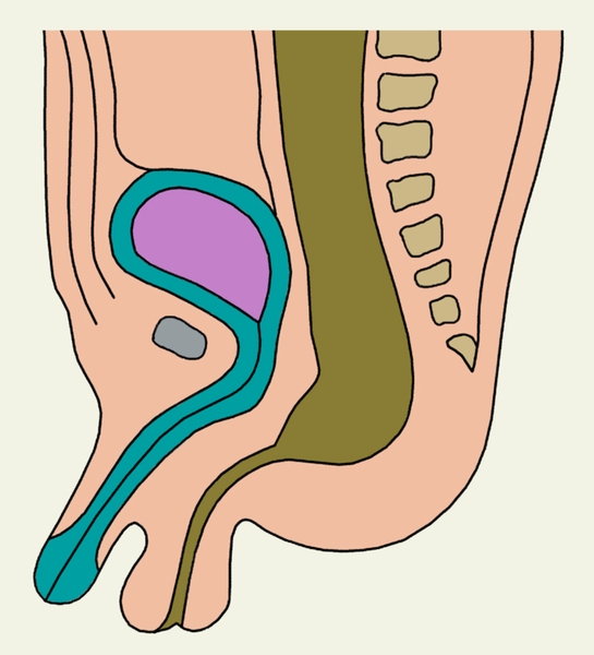 Рис. 2к). Схематическое изображение пороков развития прямой кишки и заднепроходного отверстия: атрезия прямой кишки со свищом мошонки
