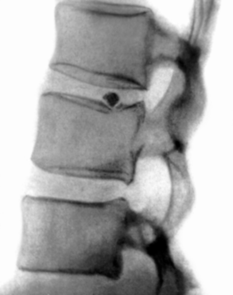 Рис. 7б). Рентгенограмма позвоночника (боковая проекция) при кальцификации межпозвоночных дисков: кальцификация части <a href=