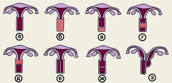 Рис. 2. Схематическое изображение некоторых пороков развития влагалища и матки: а — <a href=