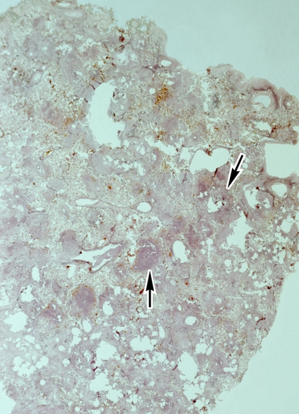 Рис. 10. Гистотопографический срез легкого при казеозной пневмонии: в легочной ткани видны сливные пневмонические очаги с намечающимся распадом (указаны стрелками)