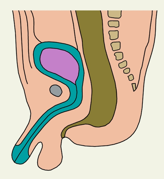 Рис. 2и). Схематическое изображение пороков развития прямой кишки и заднепроходного отверстия: атрезия прямой кишки со свищом промежности