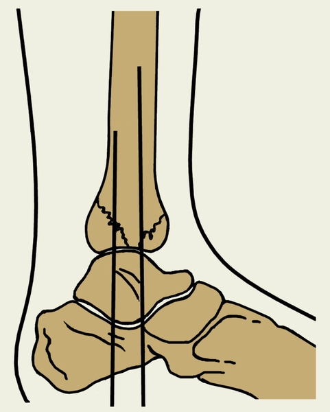 Рис. 12. Трансартикулярный остеосинтез спицами при переломах лодыжек (боковая проекция)