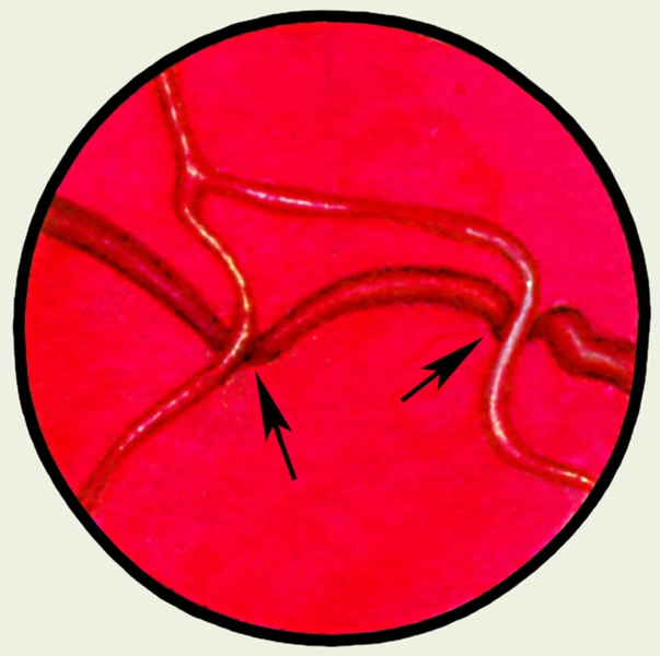 Рис. 10. Глазное дно в норме и при патологии. Изменения сосудов сетчатки при гипертонической болезни: стрелками указано сужение и дугообразное <a href=