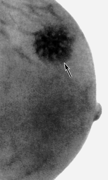 Рис. в). Маммограмма при раке молочной железы — определяется тень <a href=