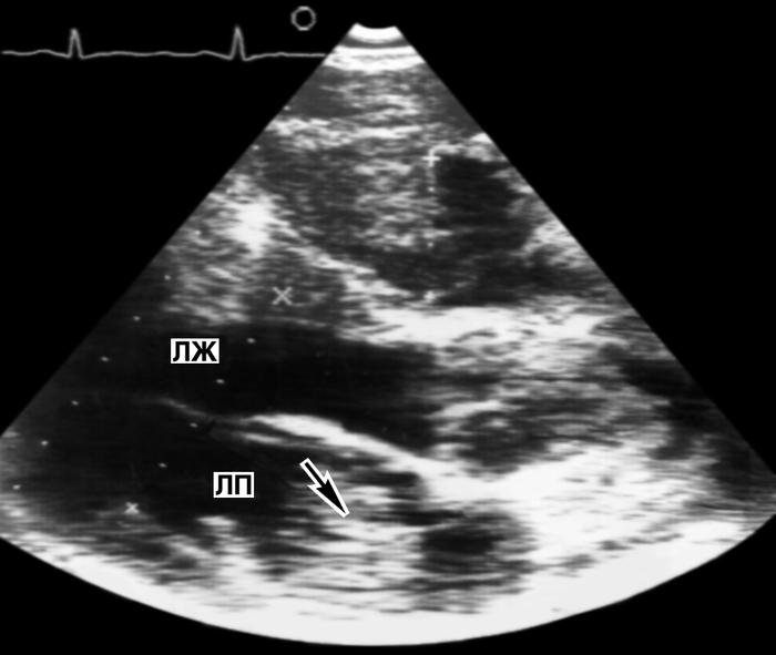 Рис. 22. Двухмерная эхокардиограмма (в проекции длинной оси сердца) больного с миксомой левого предсердия: стрелкой указано овальной формы эхопозитивное образование, расположенное в левом предсердии