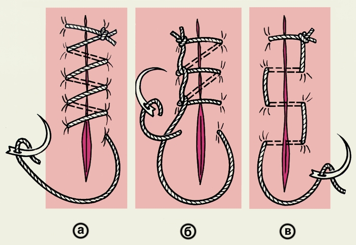 Рис. 7. Схематическое изображение простого (линейного) обвивного непрерывного шва и его вариантов: а — простой обвивной шов; б — обвивной шов по Мультановскому; в — матрацный шов