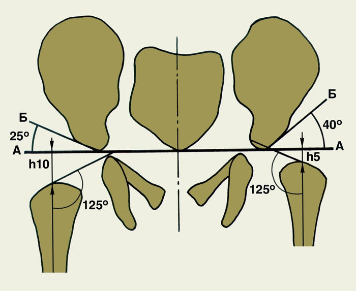 Рис. 5. Схема определения взаимоотношения костей, образующих тазобедренный сустав: АА — основная горизонталь; Б — линия, проводимая вдоль контуров костной части свода вертлужной впадины; α — угол Хорвата между линиями АА и Б (угол наклона свода вертлужной впадины); h — высота стояния диафиза — перпендикуляр, восстановленный от средней точки верхнего конца диафиза бедренной кости до основной горизонтали (АА)