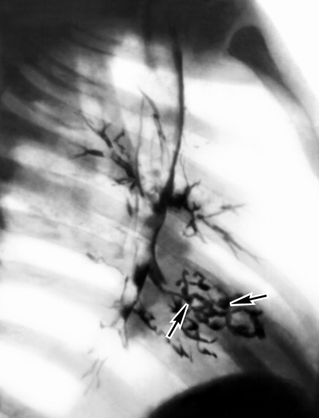 Рис. 16б). Бронхограмма в правой боковой проекции при правосторонней хронической пневмонии: расширенные бронхи указаны стрелками