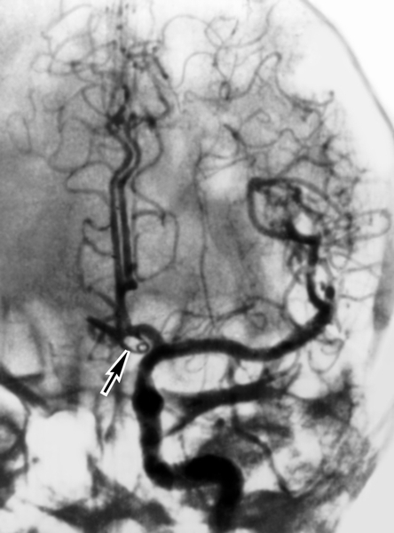 Рис. 3б). Каротидная ангиограмма (левосторонняя) больного с аневризмой передней соединительной артерии: через 10 дней после клипирования аневризмы — спазм отсутствует (клипса указана стрелкой)
