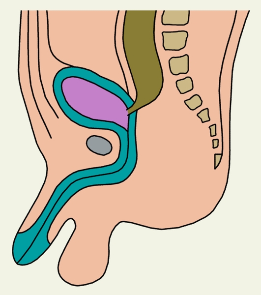 Рис. 2г). Схематическое изображение пороков развития прямой кишки и заднепроходного отверстия: атрезия прямой кишки со свищом в мочевой пузырь