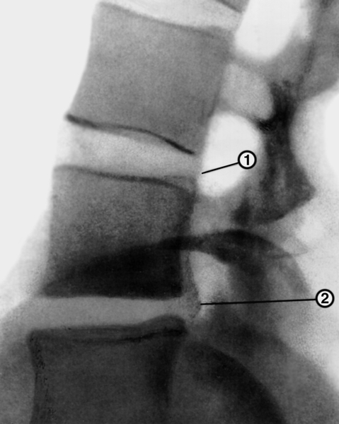 Рис. 9б). Пневмомиелограмма при остеохондрозе позвоночника (боковая проекция): протрузия диска (1) и грыжа диска (2)