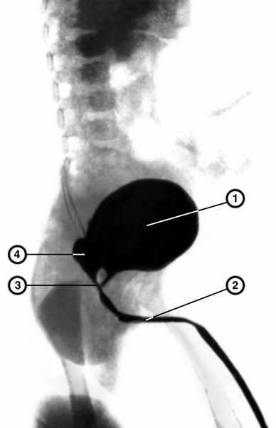 Рис. 4. Уретроцистограмма при ректоуретральном свище: 1 — мочевой пузырь; 2 — <a href=