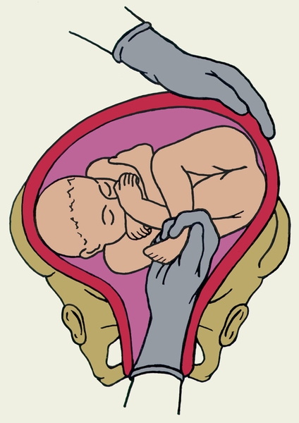 Рис. 2а). Схематическое изображение некоторых этапов наружно-внутреннего классического поворота плода на ножку при заднем виде поперечного положения плода: захватывание вышележащей ножки