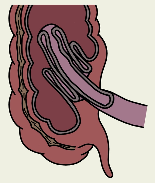 Рис. 2б). Схематическое изображение инвагинации тонкой кишки в слепую — двойная инвагинация