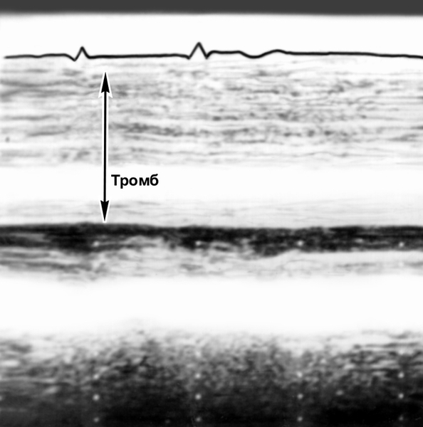 Рис. 23б). Одномерная эхокардиограмма больного с тромбом в левом желудочке сердца: на двухмерной эхокардиограмме в полости левого желудочка (темное поле) определяется интимно связанное со стенкой и выбухающее в полость плотное эхопозитивное образование (указано стрелкой), которое в одномерном изображении представляется слоистым, заполняющим почти всю полость левого желудочка