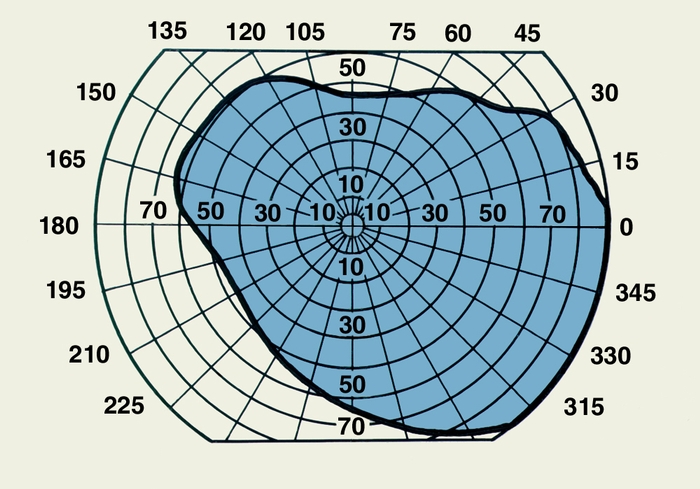 Рис. 2а). Схема поля зрения, полученная при периметрии левого глаза с использованием белого тест-объекта (выпавшие участки обозначены голубым цветом): при терминальной стадии пигментной дегенерации сетчатки (трубчатое поле зрения)
