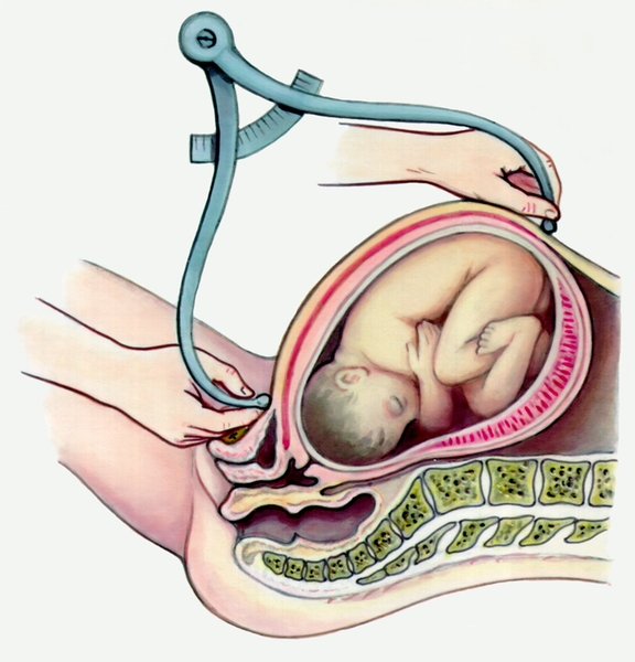 Рис. 4. Схематическое изображение измерения плода тазомером (при продольном расположением плода)